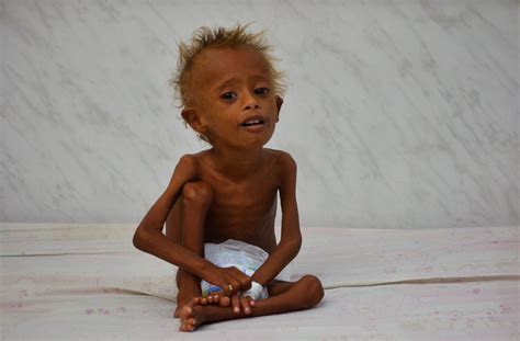 A child in Yemen dies of malnutrition every 10 minutes ...