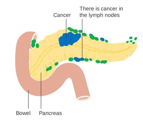 A Diabetes Diagnosis May be First Symptom of Pancreatic Cancer