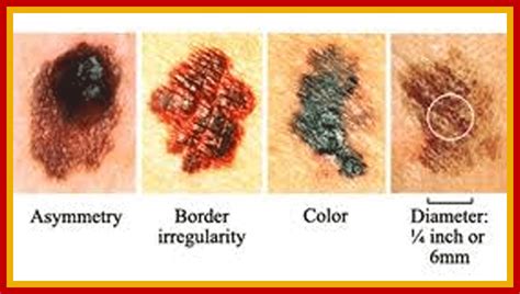 A melanoma is a malignant form of skin cancer and is one ...