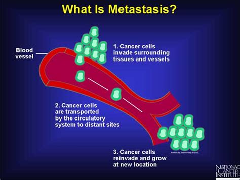 A New Cancer Treatment Manages To Prevent Metastasis