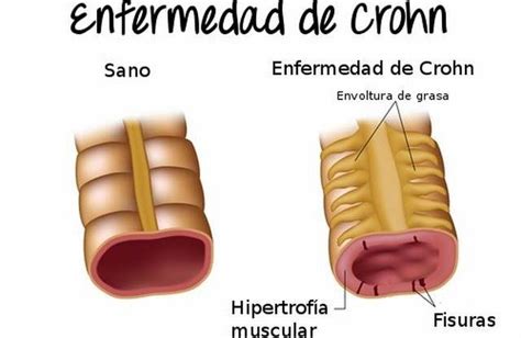 ¿A qué parte del cuerpo afecta la enfermedad de Crohn ...