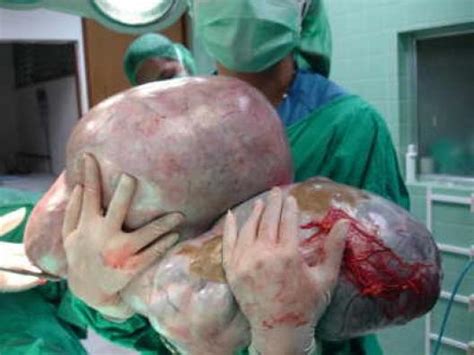 A una mujer taiwanesa le extirpan un tumor de 22 kilos en ...