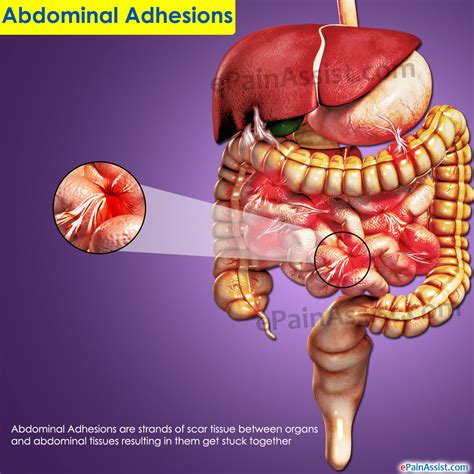 Abdominal Adhesions: Treatment, Prevention, Diet, Symptoms ...