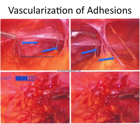 Abdominal Surgery: Abdominal Surgery To Remove Adhesions