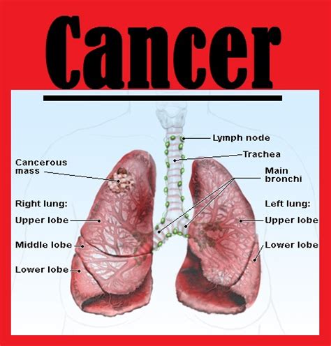 about lung cancer 3000