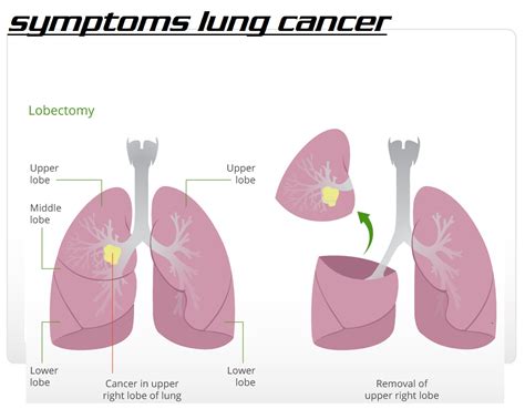 about lung cancer 3000