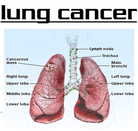 about lung cancer 3000