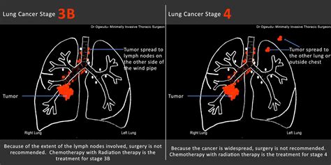 About  stage 4 lung cancer symptoms |Ovarian Cancer FAQ ...