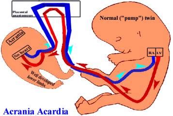Acardiac Acrania
