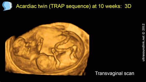 Acardiac twin  TRAP sequence  at 10 weeks   YouTube