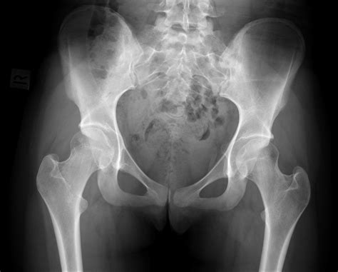 Acetabular retroversion and protrusio | Radiology Case ...