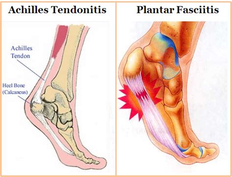 Achilies Tendinitis | China| PDF | PPT| Case Reports ...