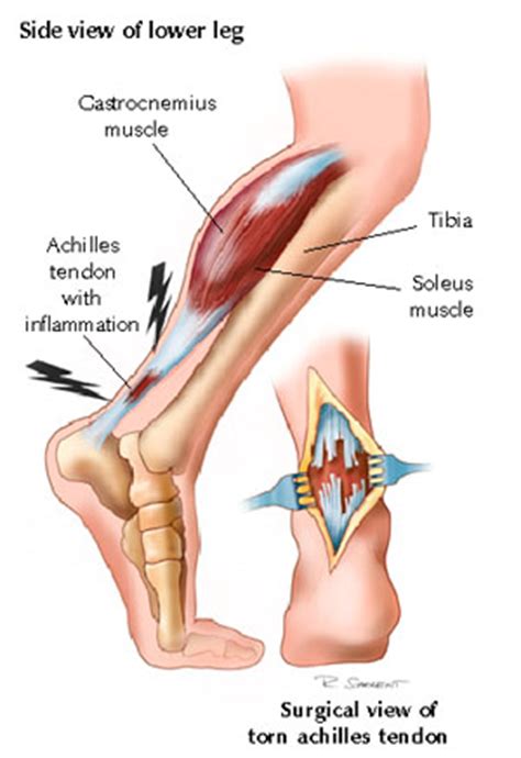 Achilles Heel Pain Causes: How to Treat Achilles Tendon ...