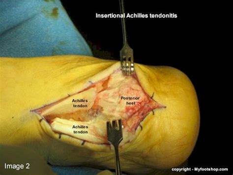 Achilles Tendinitis | Causes and treatment options ...