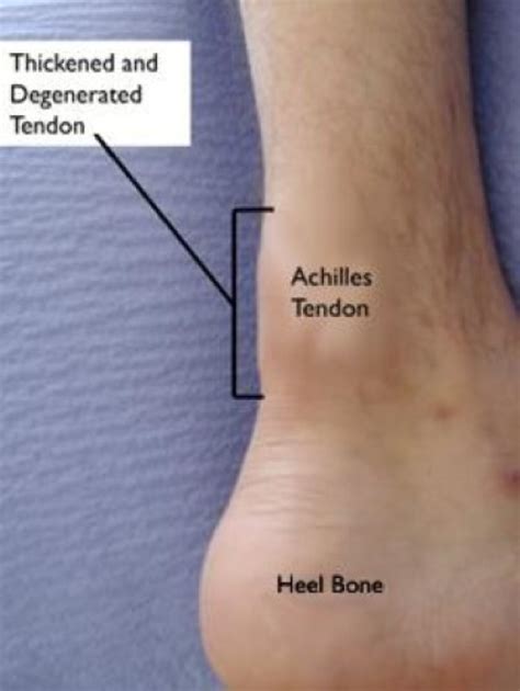 Achilles Tendinitis   OrthoInfo   AAOS