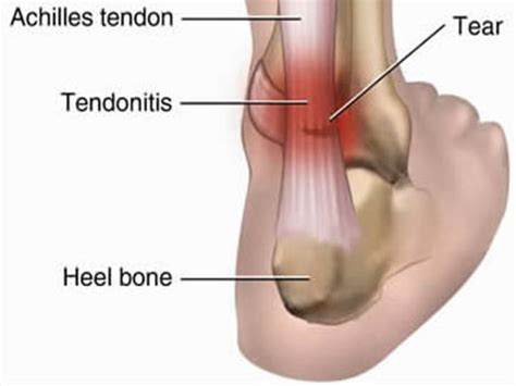 Achilles Tendinopathy