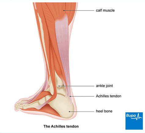 Achilles tendinopathy | Treatment and Symptoms | Bupa UK