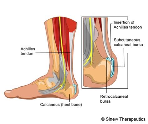 Achilles Tendon Bursitis Information   Sinew Therapeutics