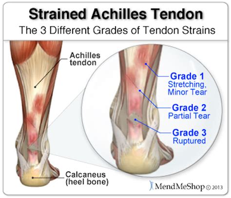 Achilles tendon injuries and running   readpt.com