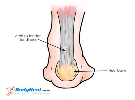 Achilles Tendon Injuries: Tendonitis, Tendinosis, Tear ...