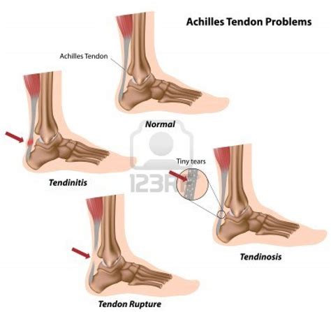Achilles Tendon InjuriesProgressive Physical Therapy
