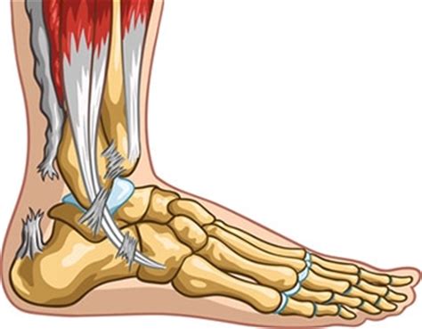 Achilles Tendon Injury, Rupture, Surgery, Treatment and ...