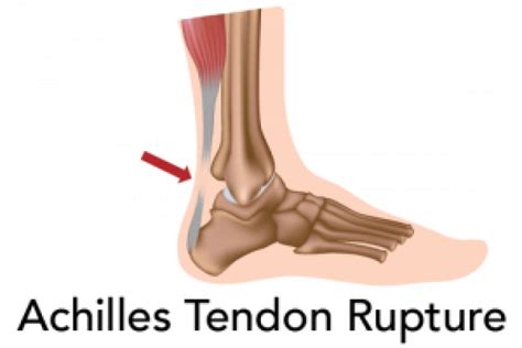 Achilles Tendon Repair Rehab Protocol