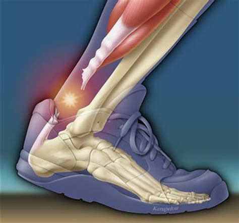 Achilles tendon rupture | Bones, joints, muscles diseases ...