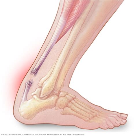 Achilles tendon rupture   Mayo Clinic