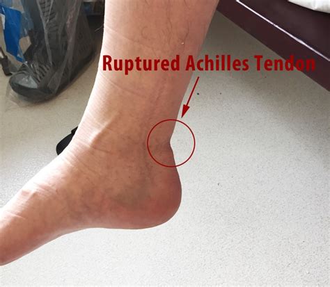 Achilles Tendon Rupture Non Surgical Recovery and Proper ...