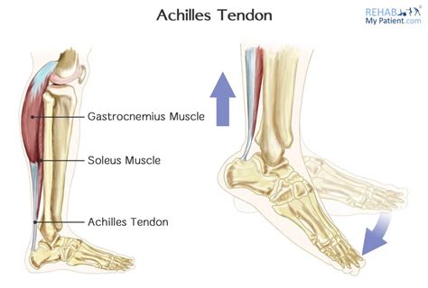 Achilles Tendon Rupture | Rehab My Patient