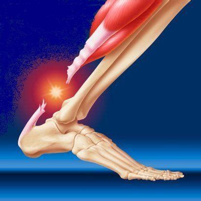 Achilles Tendon Rupture Treatment in Coral Springs, Florida