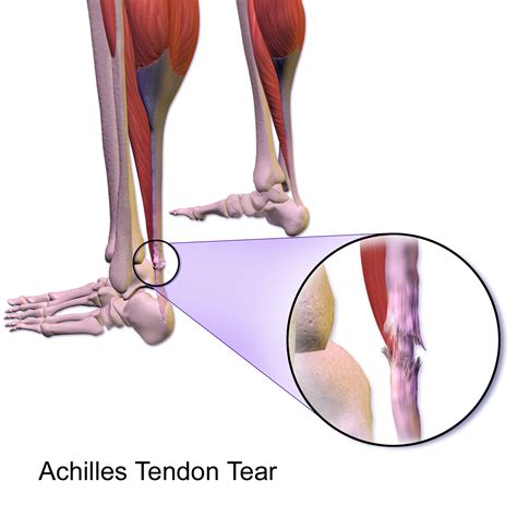 Achilles tendon rupture   Wikipedia