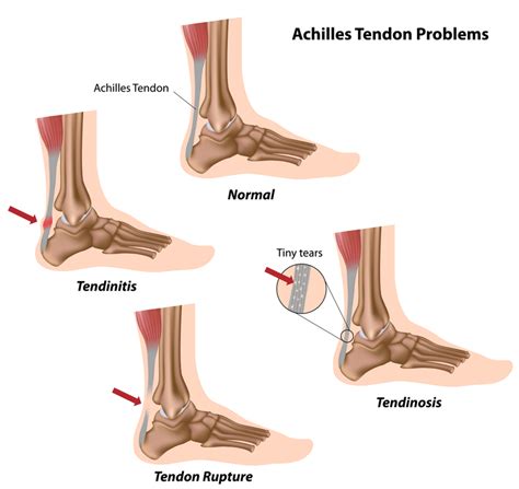 Achilles Tendon Tear | Kansas City Bone & Joint Clinic