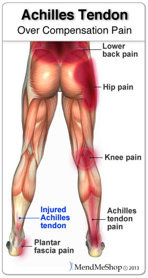 Achilles Tendonitis Information and Effective Treatments ...