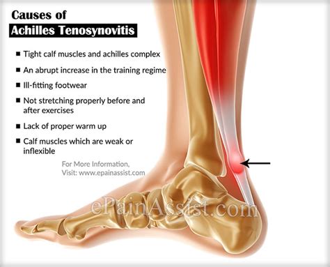 Achilles Tenosynovitis|Symptoms|Causes|Treatment|Recovery ...
