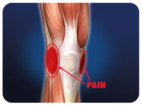ACL & MCL Knee Ligament Injuries | Pro Tec Athletics