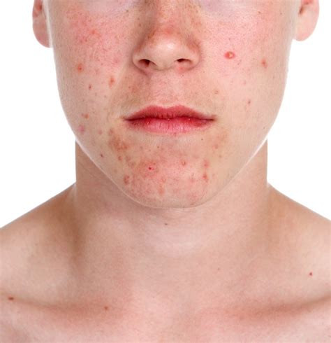 Active Treatments To Cure For Chronic Acne | The ...