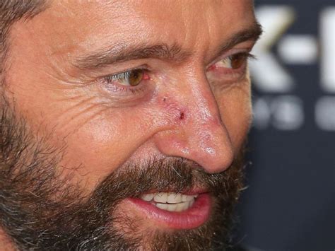 Actor Hugh Jackman has sixth skin cancer removed from his nose