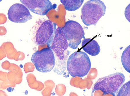 Acute myelogenous leukaemia   Investigations | BMJ Best ...