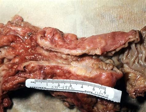 Adenocarcinoma of the colon: gross pathology | Image ...