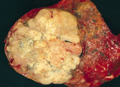 Adenocarcinoma of the lung   Wikipedia