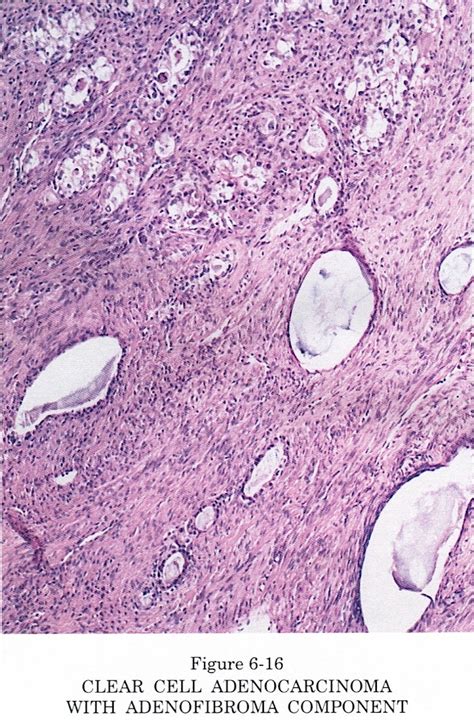 Adenocarcinoma: Ovarian Clear Cell Adenocarcinoma