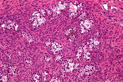 Adenocarcinoma: Ovarian Clear Cell Adenocarcinoma