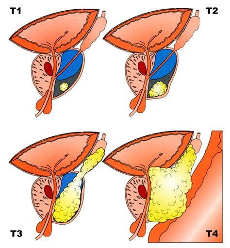 ADENOCARCINOMA PROSTÁTICO | Binipatia e higienismo