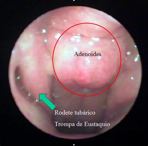 Adenoidectomía | Dr. Carbonell – Otorrinolaringología ...