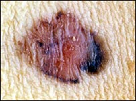 Agridulce » Blog Archive » Logran curar cáncer de piel