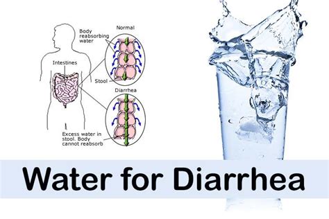 Agua para la Diarrea   SaludAIO