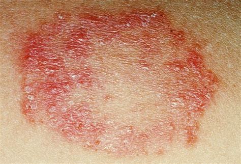 All About Types Of Fungal Infection – Health Slice!