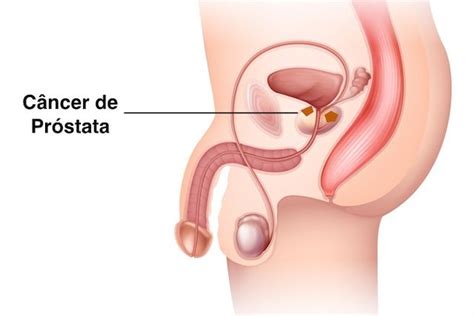 Alterações da próstata: sintomas, diagnóstico e tratamento